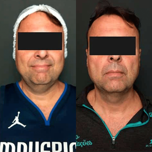 antes-depois-10
