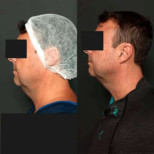antes-depois-11
