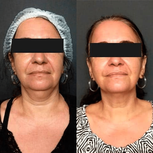 antes-depois-12