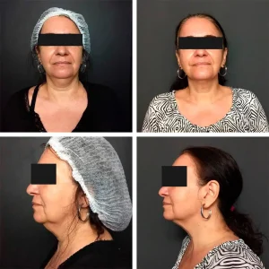 antes-depois (2)