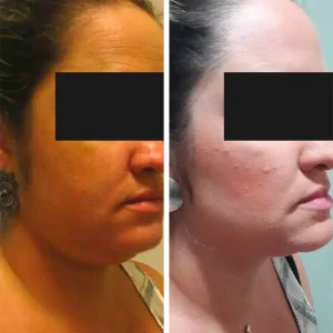 antes-depois (4)