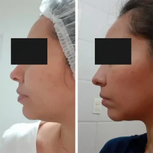 antes-depois (5)