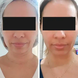 antes-depois (6)